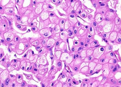 Carcinoma