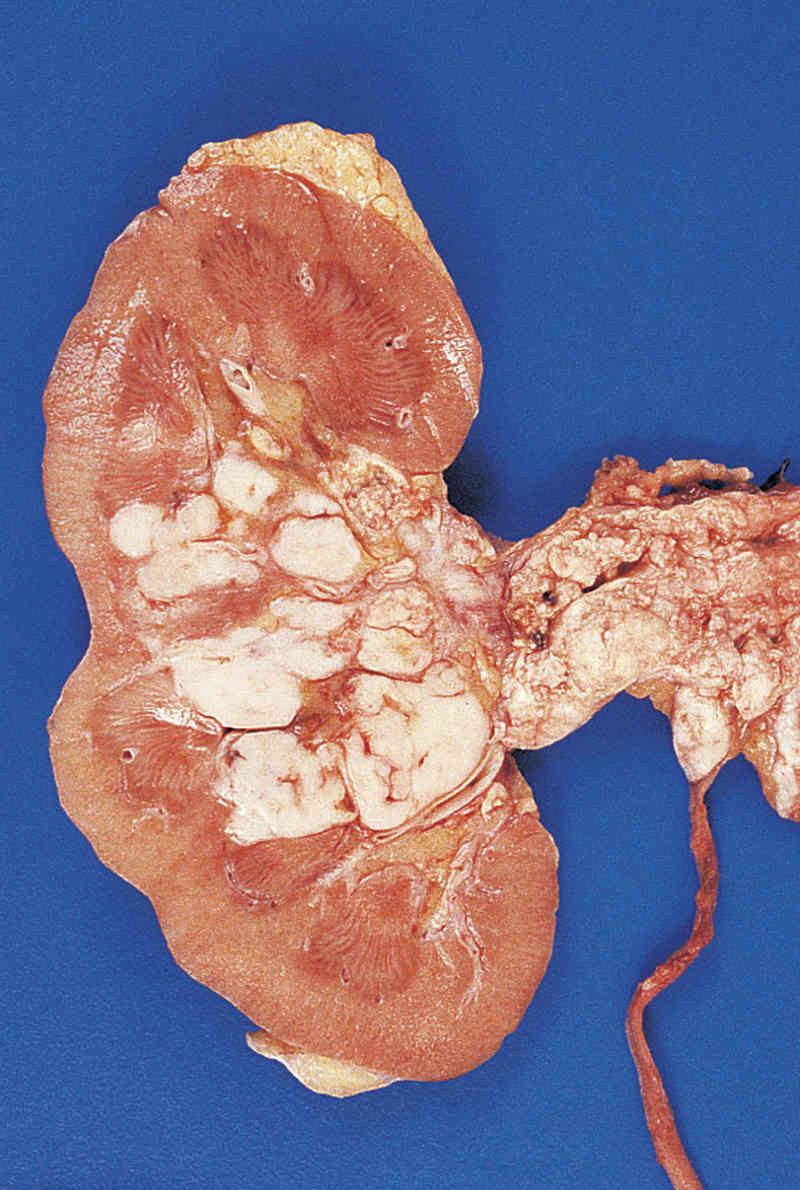 Carcinoma
