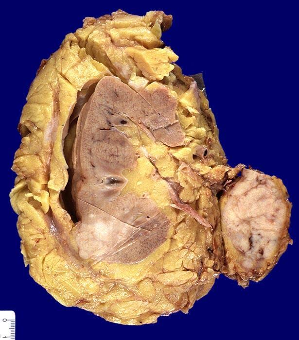 Carcinoma renocellulare