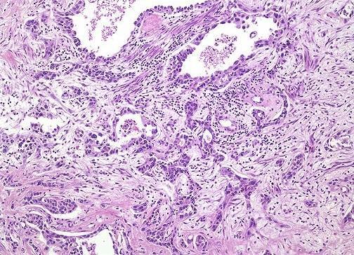 Carcinoma renocellulare renis