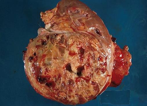 (lipid) tumor.