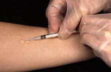 Tuberkulin bőrpróba: Mantoux teszt szűrővizsgálat: PPD