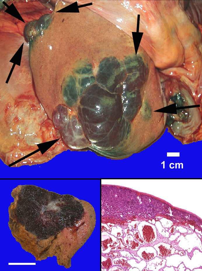 Haemangioma hepatis (óriás, többszörös. Lehet igen kicsiny és szoliter is!