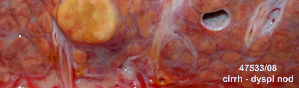 Dysplastic Nodule (LGDN) High-grade Dysplastic