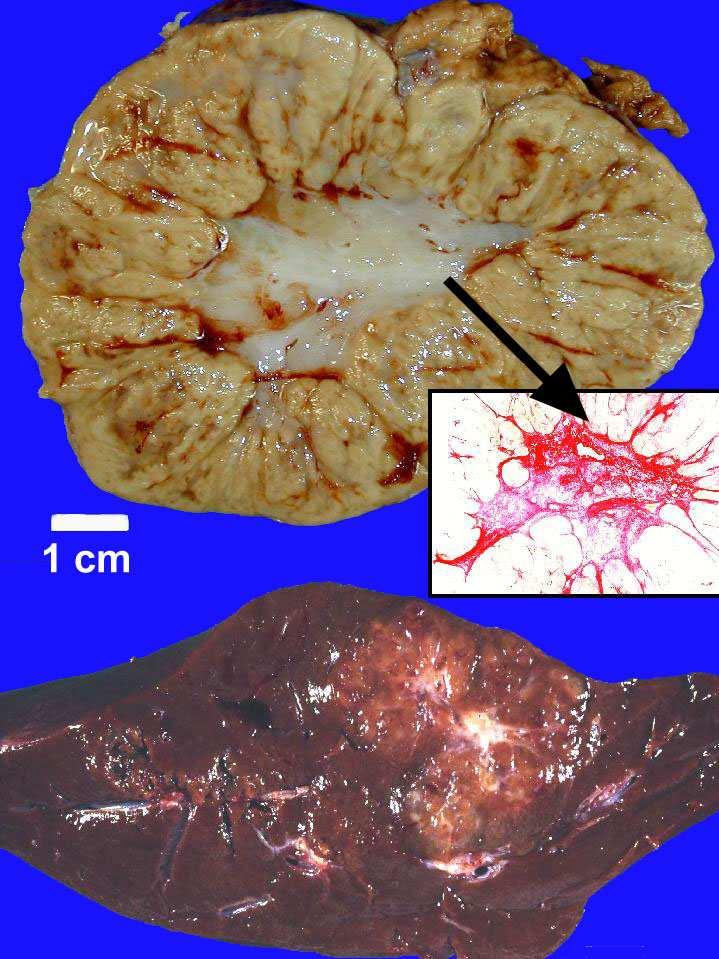 Focalis nodularis hyperplasia (FNH)(**) - éles határ - tok nincs - centrális heg - szín