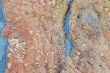 Adiponecrosis (Zsírnecrosis ) Acut pancreatitisben (alcoholos, epeúti eltáródás mellett, hypercalcaemia, hypercholesterinaemia, ERCP-iatrogen Pancreas enzimek aktiválódnak, felszabadulnak (lipázok,