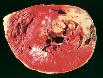 Myocardialis infarctus (MI) Macroscopia: -2-3 órás: NADH dehydrogenase + NBT (tetrazolium teszt, diaphorase reakció) -kevesebb, mint 12 órás: nem