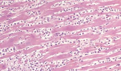 hegképződés, fibrosis Microscopia: 4-12 órás: coagulatios necrosis kezdődik + oedema -12-24 óra: nuclearis elváltozások (karyorrhexis, -pyknosis),