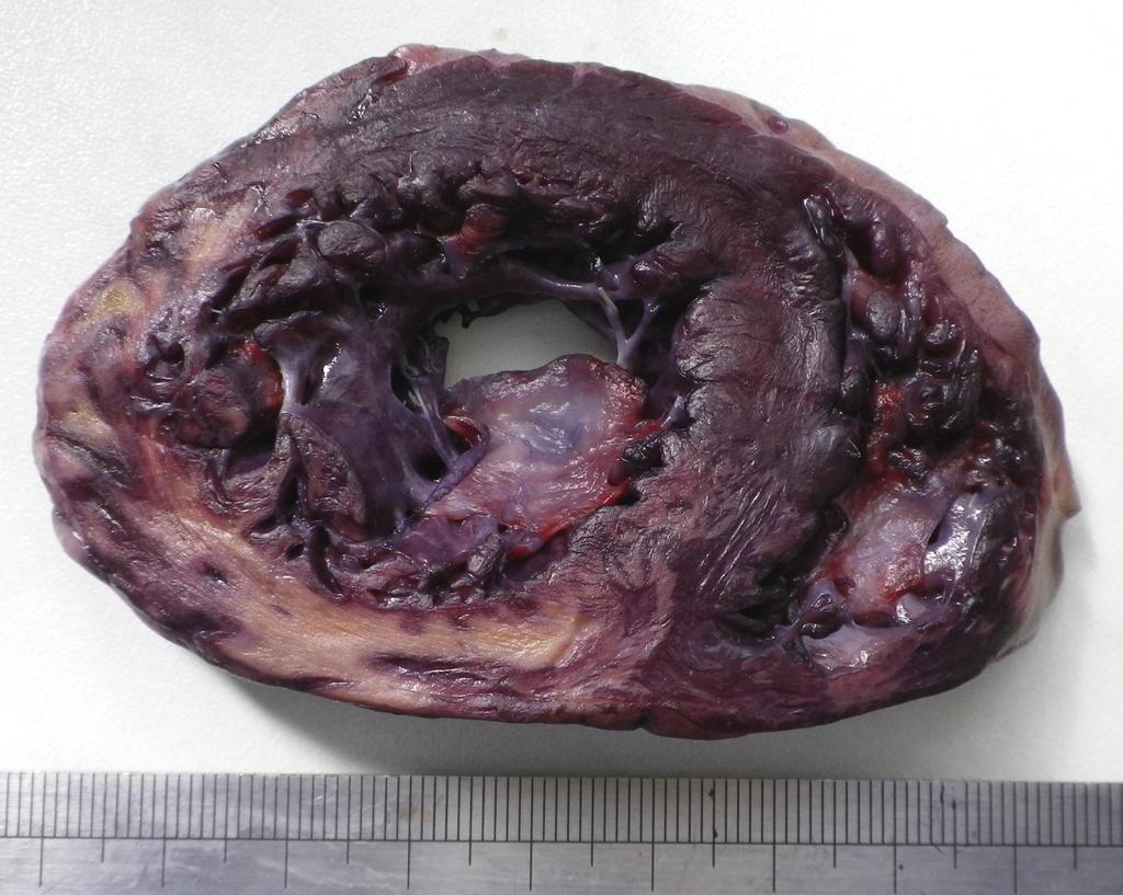 Friss myocardialis
