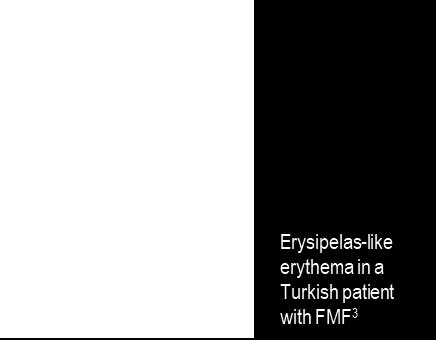 duzzanat (erysipelas-szerű erythema) A fehérvérsejtek számának növekedése (leukocitózis) ESR CRP, SAA A reaktív amiloidózis (AAA) - amelyet az szérum amyloid fehérje (SAA) lerakódása okoz - az FMF
