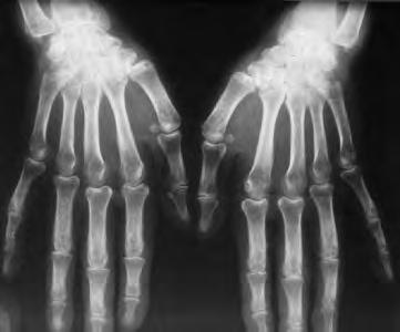 Klinikai tünetek Leggyakoribb klinikai jellemzők Nem gyakori jellemzők Ízületi fájdalom Leggyakoribb tünet (a betegek 70 100%-a) Arthralgia és arthritis általában a csuklókat, térdeket, bokákat