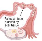 Tubo-ovarialis abscessus Hydrosalpynx (mucosa elpusztulhat)