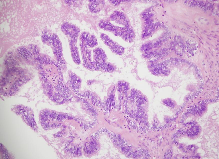 a condyloma kezelése klotrimazollal
