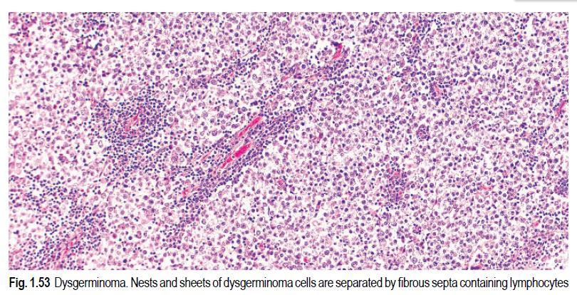 Dysgerminoma World Health