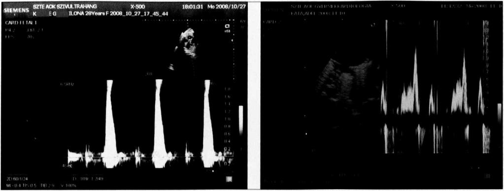 7. táblázat. A magzati ritmuszavarok és kardiális dekompenzáció terápiája Gyógyszeres Beadás/beavatkozás kezelés Javallat módja Digoxin SVT, fluttern Transplacentaris (iv./po.