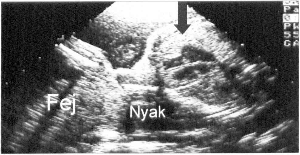 32 Szakm ai aktualitások 2. ábra. Második trimeszteri transabdominalis foetalis echokardiográfia. Normális nagyságú szív. szabályos négyüregi kép (19.
