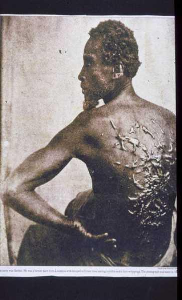 Keloid Alibert, 1806 abnormális heg: