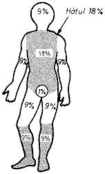 Az égési sérülés súlyosságának meghatározása a megégett testfelület nagysága alapján A szabály lényege, hogy a sérült testét