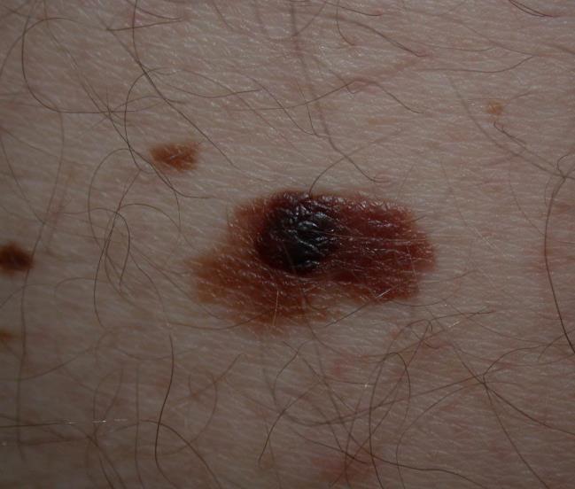 MELANOMA MALIGNUM Talán a legközismertebb, rettegetten