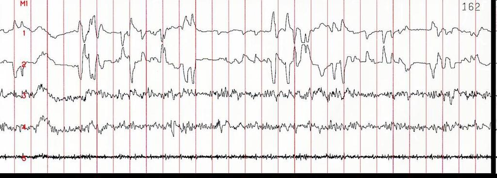 szemmozgás REM - 90-100 percenként, kb 25 percig tartó állapot -Kis amplitúdójú, nagy frekvenciájú hullámok (beta 15-30, gamma 31-48 Hz) -Teljes izomtónus vesztés miközben éber agyi aktivitás (Jouvet