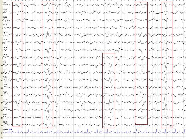 Dementiák Trifázisos epileptiform kisülések JCD > AD > kontroll Temporalis lassú hullámok DLBD > AD Lassú aktivitás (cholinerg aktivitás) DLBD>AD/ApoE4 > AD > FTD Huntigton kór: low voltage