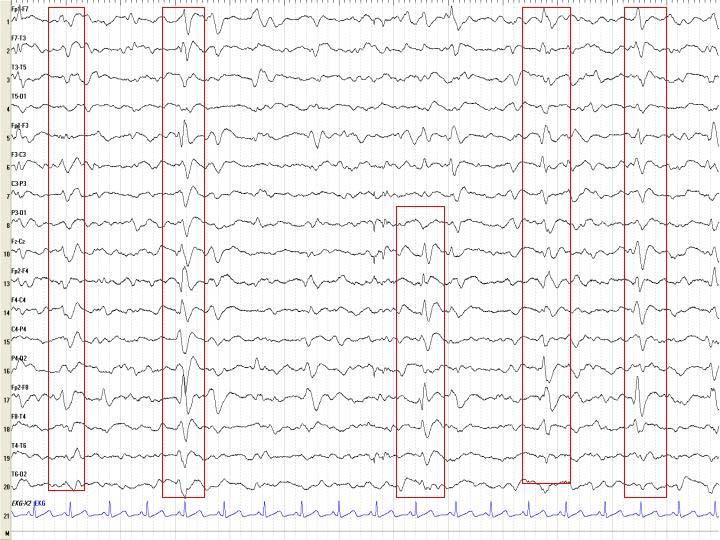 Dementiák Trifázisos epileptiform kisülések JCD > AD > kontroll Temporalis lassú hullámok DLBD > AD Lassú aktivitás (cholinerg aktivitás) DLBD>AD/ApoE4 > AD > FTD Huntigton kór: low voltage