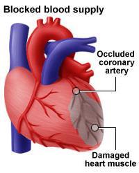 SZÍV VÉRELLÁTÁSA koszorúartériákon keresztül (arteria coronaria) Funkcionális végartériák: ha egy elzáródik, az általa ellátott szívizomzat
