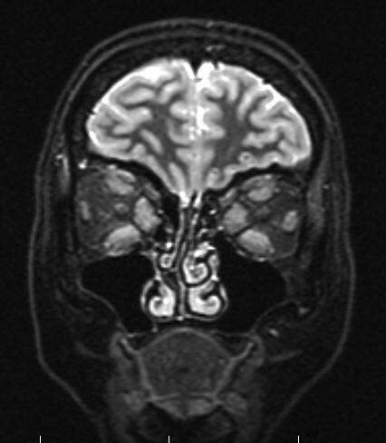 A) EOP B) Ocularis lymphoma (első eset) C) Idiopathiás inflammatorikus orbitopathia (második eset) D) IgG 4 -orbitopathia (harmadik eset) 1.