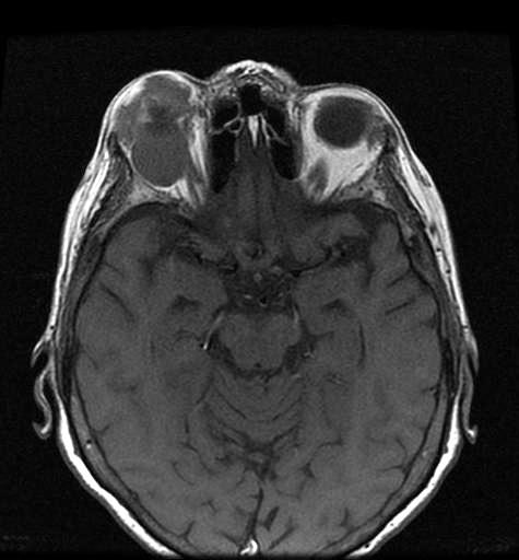 A rectus medialis és inferior mindkét orbitában jelentősen megvastagodott, a többi szemmozgató izom érintettsége kisebb mértékű B) Ocularis lymphomában szenvedő beteg (első eset) orbita-mr-képe.