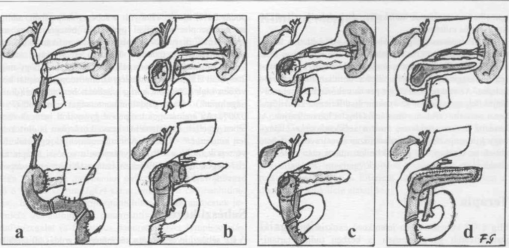 DOPPHR - duodenum- és szervmegtartó pancreasfej-resectio (Büchler-Farkas-módosítás); d) LPJ-LPHR - longitudinális pancreatico-jejunostomia és limitált pancreasfejresectio (Frey-műtét) Resectiós