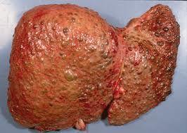 Hatása a fizikai egészségre májcirrhosis, pancreatitis, epilepsia, polyneuropáthia,