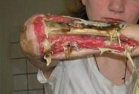Krokodil (Desomorphine) Opiát analóg 1932-ben szintetizálták Permoid néven Svájcban, gyógyszerként forgalmazták, 2002-ben jelent meg az otthoni készítésű formája