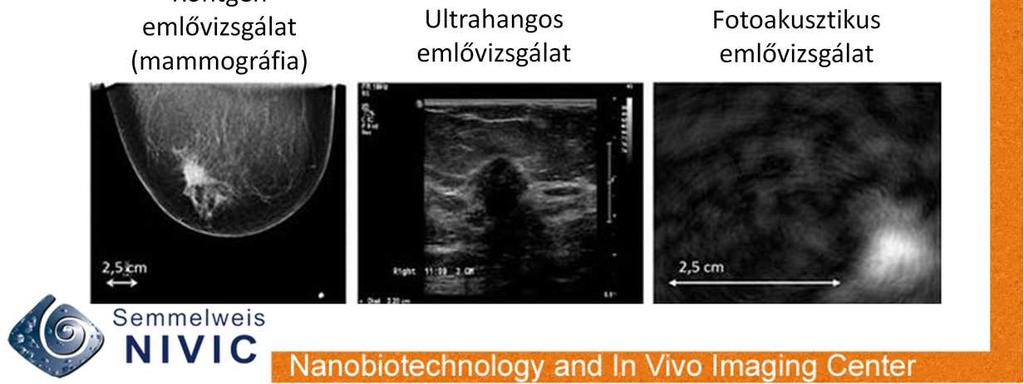 A másik lehetőség az ultrahang (főleg fiatal korban, terhességnél használjuk az emlő vizsgálatában) és az MRI (főleg öröklődő elváltozásoknál, daganat újboli megjelenésének gyanújakor, egyéb