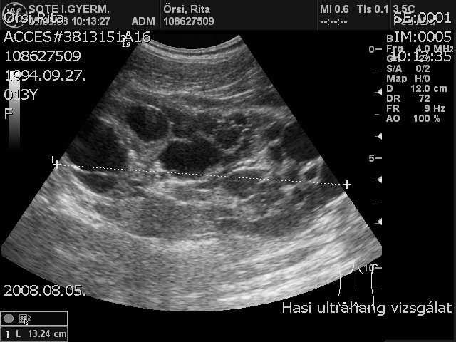 Polycystás vese Autoszomális domináns (ADPKD), cysták a nephron teljes