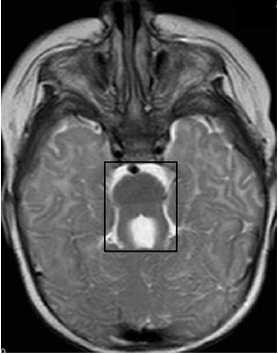Joubert-syndroma cerebellaris ataxia, (vermis aplasia) hypotonia, oculomotoricus apraxia