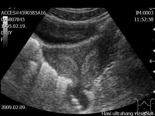 Multicystás dysplasiás vese +/- uretercsonk