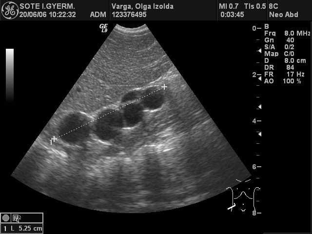 oesophagus atresia, anus atresia, vitium,