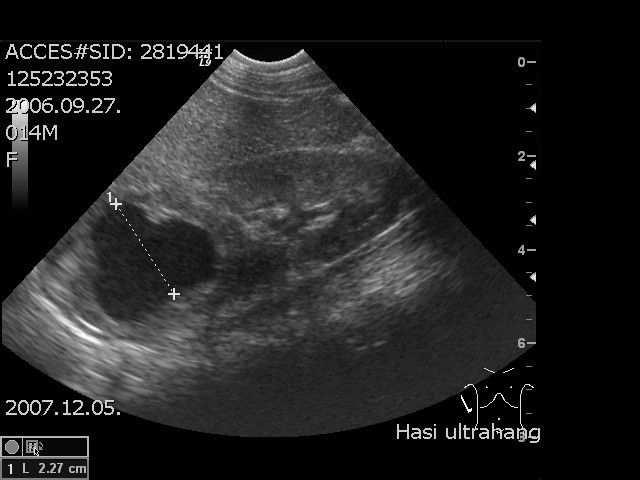 Cystás vesék differenciál diagnosis Hydronephrosis Kettıs