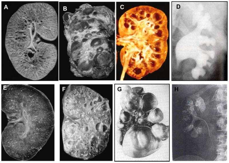 Am J Med Genet C Semin Med Genet. 2009 A. ARPKD, microcystás, nem obstruktiv győjtıcsatorna tágulat, B.