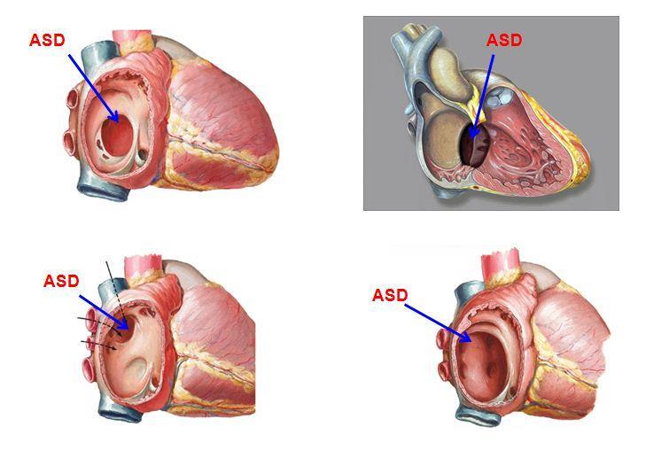 Pitvari septumdefectus (ASD) ostium secundum defectus