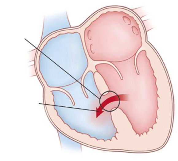 Kamrai septumdefectus (VSD)