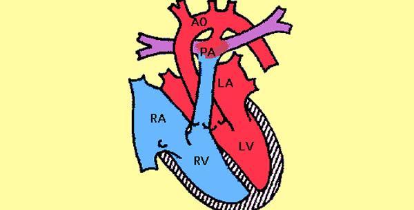 Ductus Botalli (arteriosus)