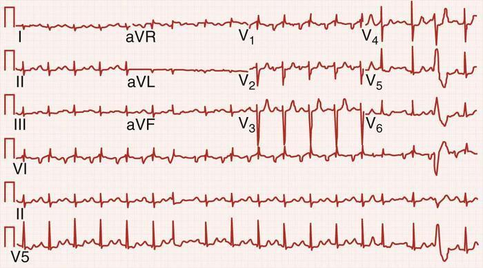 Mitralis stenosis EKG kép II: széles P V1: bifasisos,