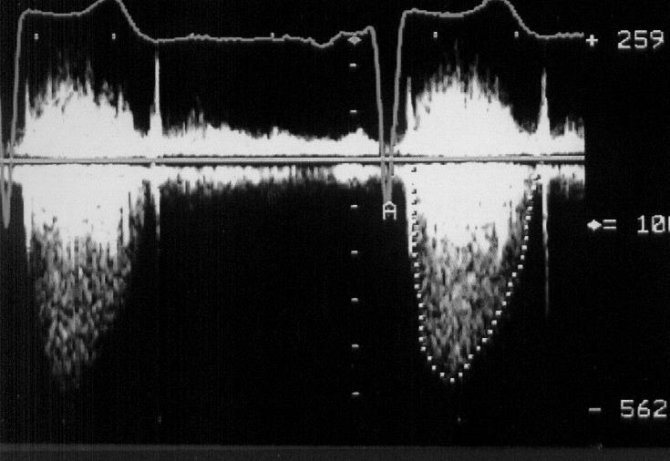 Aortastenosis Bernoulli képlet ΔP = 4v 2 I.