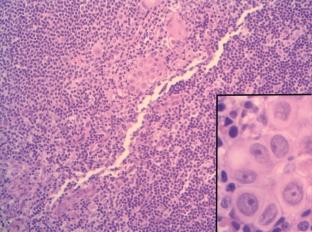 1. ábra. Amelanotikus melanomasejtek nyirokcsomóban. Kis nagyítással a nyirokcsomó mûvi hasadása mellett lévô sejtek nem szembetûnôek, bár nagyobb nagyítással a metastasis egyértelmû.