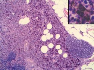 elégtelennek tûnik, és a cutan rosszindulatú daganatok SN-biopsziájával kapcsolatos augsburgi konszenzus is ennél több metszési sík vizsgálatát rögzíti ajánlásként (15).