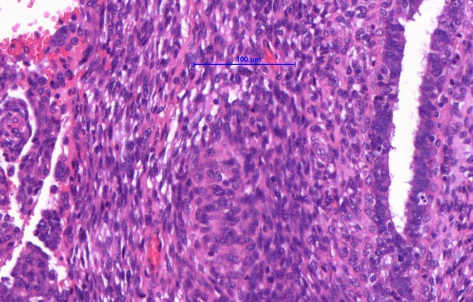 Phylloid tumorok viselkedése Benignus (többség) > Borderline > Malignus (vagy low intermedier és high grade)