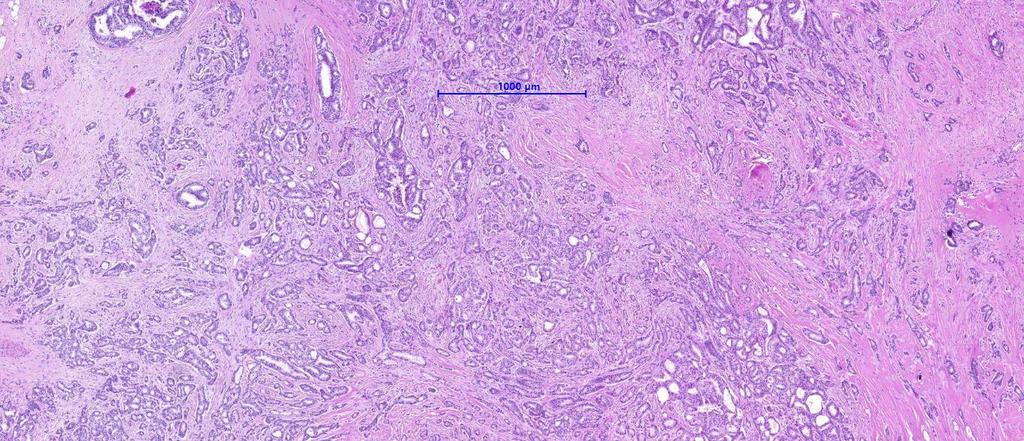 Invazív carcinoma NST A tumorsejtek tubulusokba,