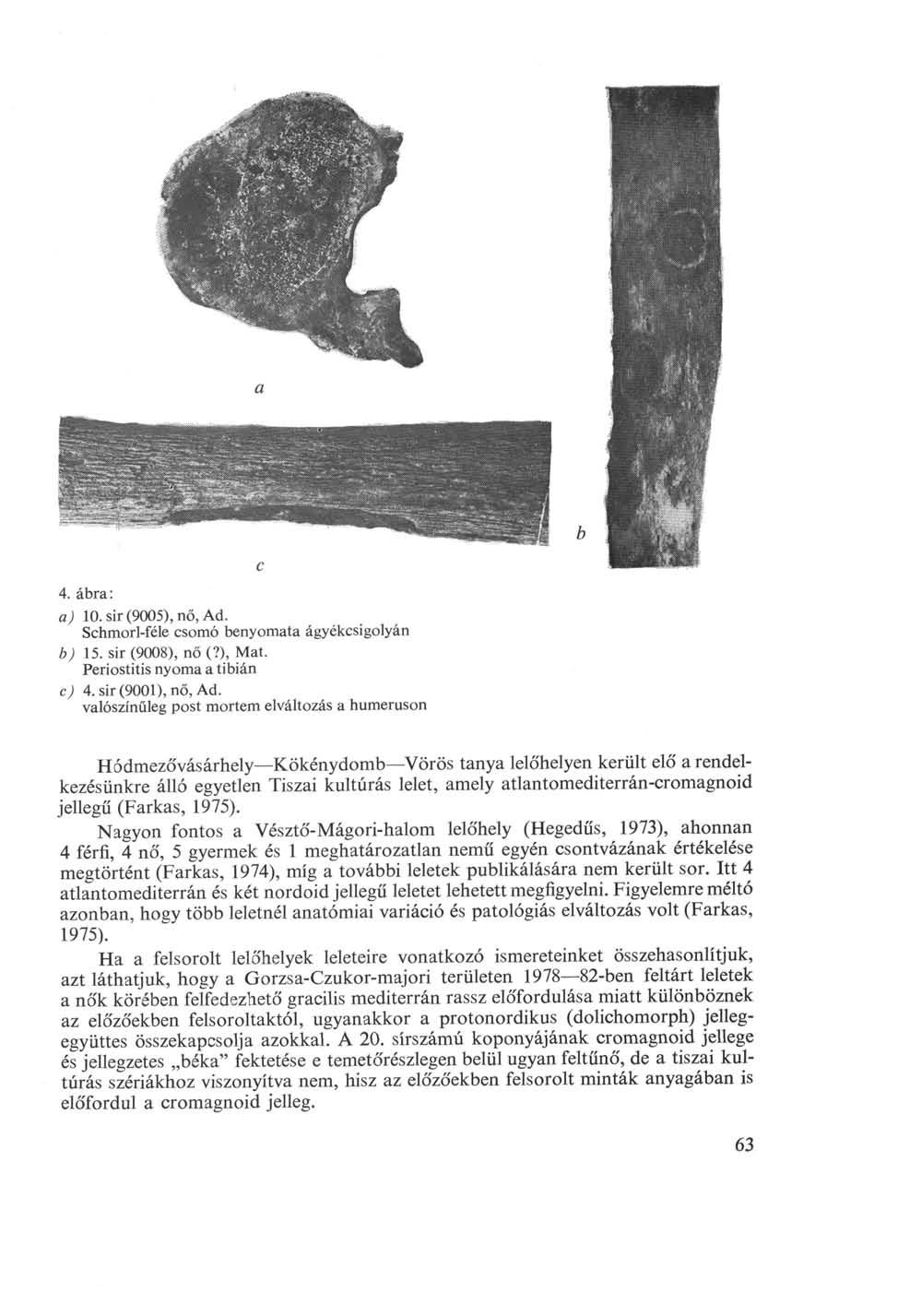 4. ábra: a) 1. sir (95), nő, Ad. Schmorl-féle csomó benyomata ágyékcsigolyán b) 15. sir (98), nő (?), Mat. Periostitis nyoma a tibián c) 4. sir (91), nő, Ad.
