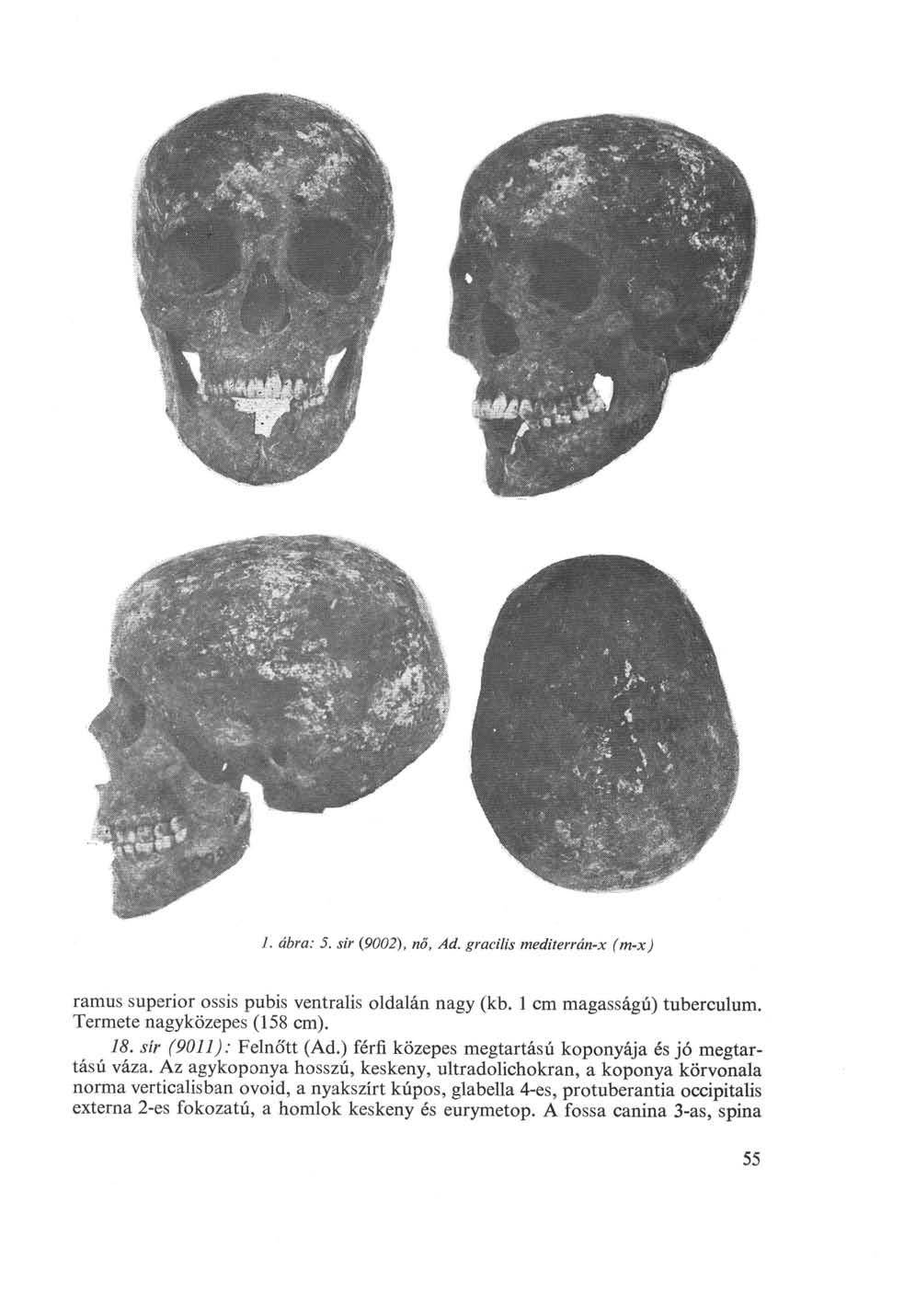 1. ábra: 5. sir (92), nő, Ad. gracilis mediterrán-x (m-x) ramus superior ossis pubis ventralis oldalán nagy (kb. 1 cm magasságú) tuberculum. Termete nagyközepes (158 cm). 18. sír (911): Felnőtt (Ad.